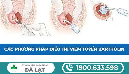 Hình ảnh minh họa